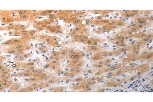 Immunohistochemistry of paraffin-embedded Human liver cancer using NQO2 Polyclonal Antibody at dilution of 1:50 (NQO2 anticorps)