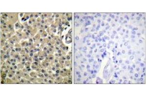 Immunohistochemistry analysis of paraffin-embedded human breast carcinoma tissue, using CD227/Mucin 1 (Ab-1243) Antibody. (MUC1 anticorps  (AA 1204-1253))
