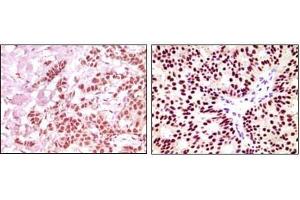 Immunohistochemical analysis of paraffin-embedded human breast carcinoma, using ER-alpha antibody showing nuclear expression with DAB staining. (Estrogen Receptor alpha anticorps  (AA 410-592))