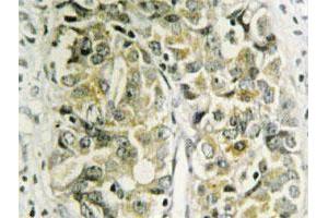 Immunohistochemical analysis of paraffin-embedded human prostate cancer tissue using LGALS8 polyclonal antibody . (LGALS8 anticorps)