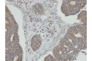 IHC-P Image Immunohistochemical analysis of paraffin-embedded human endo mitral ovarian cancer, using PPM1K, antibody at 1:100 dilution.