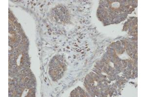 IHC-P Image Immunohistochemical analysis of paraffin-embedded human endo mitral ovarian cancer, using PPM1K, antibody at 1:100 dilution. (PPM1K anticorps)