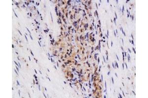 Formalin-fixed and paraffin embedded human colon carcinoma labeled with Anti-SynCAM/TSLC1 Polyclonal Antibody, Unconjugated  at 1:200 followed by conjugation to the secondary antibody and DAB staining. (CADM1 anticorps  (AA 365-442))