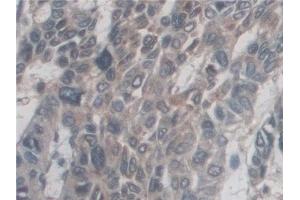 Detection of CD209 in Human Liver cancer Tissue using Polyclonal Antibody to Cluster Of Differentiation 209 (CD209)