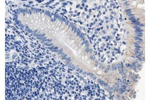 ABIN6267697 at 1/100 staining human colon cancer tissue sections by IHC-P.