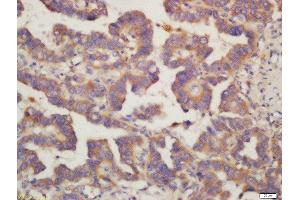 Formalin-fixed and paraffin embedded human lung carcinoma labeled with Rabbit Anti-PIG3 Polyclonal Antibody, Unconjugated (ABIN763046) at 1:200 followed by conjugation to the secondary antibody and DAB staining (MRPL41 anticorps  (AA 151-250))