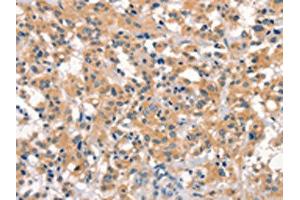 The image on the left is immunohistochemistry of paraffin-embedded Human thyroid cancer tissue using ABIN7190538(EID3 Antibody) at dilution 1/15, on the right is treated with synthetic peptide. (EID3 anticorps)