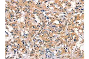 The image on the left is immunohistochemistry of paraffin-embedded Human thyroid cancer tissue using ABIN7190538(EID3 Antibody) at dilution 1/15, on the right is treated with synthetic peptide. (EID3 anticorps)