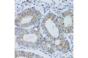 Immunohistochemistry of paraffin-embedded human colon carcinoma using DNAJC19 antibody. (DNAJC19 anticorps  (AA 1-116))