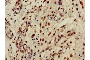 Immunohistochemistry of paraffin-embedded human lung cancer using ABIN7146768 at dilution of 1:100