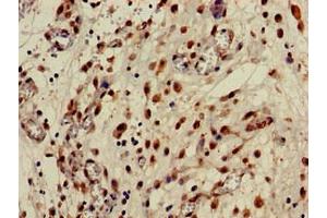 Immunohistochemistry of paraffin-embedded human lung cancer using ABIN7146768 at dilution of 1:100 (CPB2 anticorps  (AA 225-372))