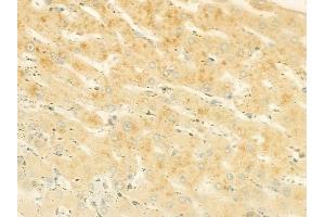 ABIN6264925 and ABIN6278520 at 1/100 staining human hepatocellular carcinoma by IHC-P. (SGCB anticorps  (N-Term))