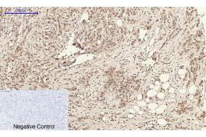 Immunohistochemical analysis of paraffin-embedded Human-kidney-cancer tissue.