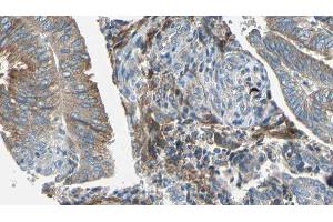 ABIN6277681 at 1/100 staining Human cervical cancer tissue by IHC-P.