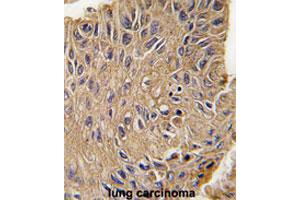 Formalin-fixed and paraffin-embedded human lung carcinomareacted with ANTXR1 polyclonal antibody , which was peroxidase-conjugated to the secondary antibody, followed by AEC staining. (ANTXR1 anticorps  (Tyr382))