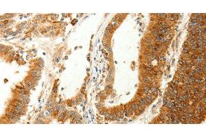 Immunohistochemistry of paraffin-embedded Human colon cancer using RARRES1 Polyclonal Antibody at dilution of 1:60 (RARRES1 anticorps)