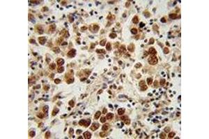 Immunohistochemistry analysis in human testis carcinoma (Formalin-fixed, Paraffin-embedded) using SOHLH1 / TEB2  Antibody (N-term), followed by peroxidase conjugation of the secondary antibody and DAB staining. (SOHLH1 anticorps  (N-Term))