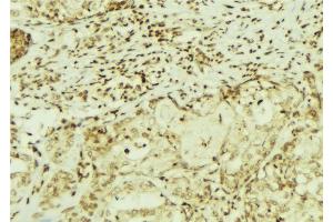 ABIN6272900 at 1/100 staining Human breast cancer tissue by IHC-P. (CEMIP anticorps  (C-Term))