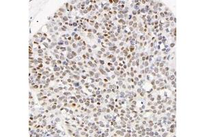 Immunohistochemistry analysis of paraffin-embedded human ovarian cancerusing ADRA1B (ABIN7072974) at dilution of 1: 1200 (ADRA1B anticorps)