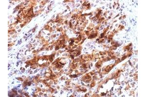 ABIN6383809 to Glypican-3 was successfully used to stain malignant cells in human hepatocellular carcinoma sections. (Recombinant Glypican 3 anticorps)