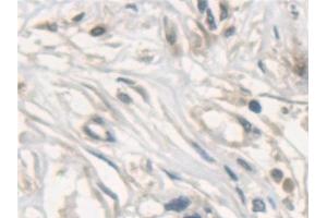 Detection of NSF in Human Stomach cancer Tissue using Polyclonal Antibody to N-Ethylmaleimide Sensitive Factor (NSF)