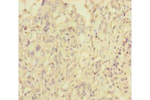 Immunohistochemistry of paraffin-embedded human pancreatic cancer using ABIN7145609 at dilution of 1:100
