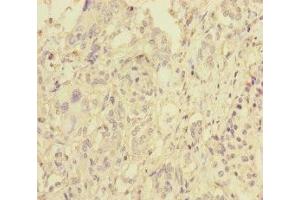 Immunohistochemistry of paraffin-embedded human pancreatic cancer using ABIN7145609 at dilution of 1:100 (Pallidin anticorps  (AA 1-170))
