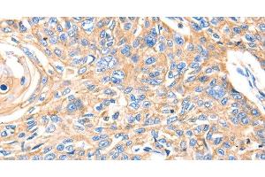 Immunohistochemistry of paraffin-embedded Human esophagus cancer using MVP Polyclonal Antibody at dilution of 1:30 (MVP anticorps)
