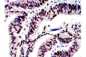 Immunohistochemical analysis of paraffin-embedded human rectum cancer tissues using c-Jun mouse mAb with DAB staining.