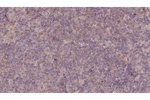 ABIN6273135 at 1/100 staining Human lymph cancer tissue by IHC-P.