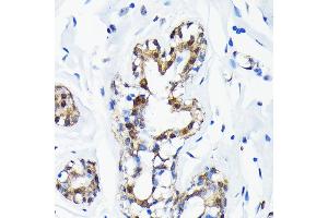 Immunohistochemistry of paraffin-embedded human breast cancer using SUMO1 Rabbit mAb  at dilution of 1:100 (40x lens). (SUMO1 anticorps)