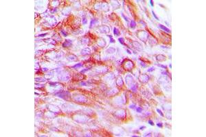 Immunohistochemical analysis of SMIT1 staining in human breast cancer formalin fixed paraffin embedded tissue section.