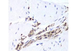 Immunohistochemistry of paraffin-embedded Human gastric cancer using TPPP3 Polyclonal Antibody at dilution of 1:100 (40x lens).