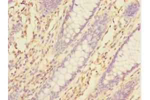Immunohistochemistry of paraffin-embedded human colon cancer using ABIN7172004 at dilution of 1:100 (TXNDC5 anticorps  (AA 1-324))
