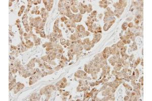 IHC-P Image Immunohistochemical analysis of paraffin-embedded OVCAR3 xenograft, using PSMB5, antibody at 1:100 dilution.