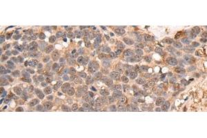 Immunohistochemistry of paraffin-embedded Human thyroid cancer tissue using ATRIP Polyclonal Antibody at dilution of 1:40(x200) (ATRIP anticorps)