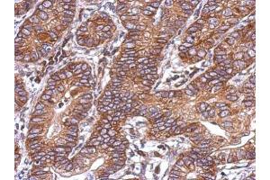 IHC-P Image Immunohistochemical analysis of paraffin-embedded human colon carcinoma, using Activin A Receptor Type IC, antibody at 1:500 dilution. (ACVR1C/ALK7 anticorps  (Center))