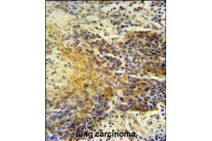 MRPS24 antibody immunohistochemistry analysis in formalin fixed and paraffin embedded human lung carcinoma followed by peroxidase conjugation of the secondary antibody and DAB staining.