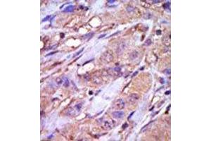 Formalin-fixed and paraffin-embedded human cancer tissue reacted with the primary antibody, which was peroxidase-conjugated to the secondary antibody, followed by DAB staining. (CK1 epsilon anticorps  (C-Term))