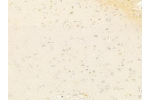 ABIN6261830 and ABIN6278360 at 1/100 staining human glioblastoma by IHC-P. (TLS/FUS (C-Term) anticorps)