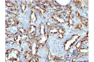 Formalin-fixed, paraffin-embedded human Angiosarcoma stained with CD31 Mouse Monoclonal Antibody (C31.