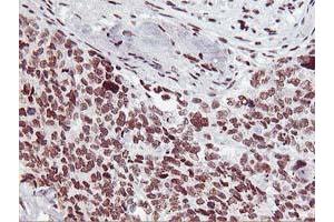 Immunohistochemical staining of paraffin-embedded Adenocarcinoma of Human breast tissue using anti-HOXC11 mouse monoclonal antibody. (HOXC11 anticorps  (AA 1-304))