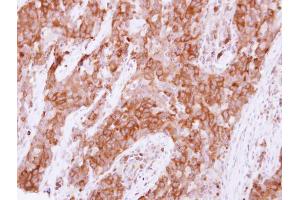 IHC-P Image Immunohistochemical analysis of paraffin-embedded human lung papillory adenocarcinoma, using Pez, antibody at 1:500 dilution. (PTPN14 anticorps  (C-Term))