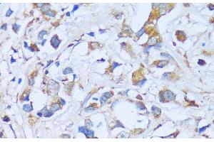 Immunohistochemistry of paraffin-embedded Human breast cancer using ACADSB Polyclonal Antibody at dilution of 1:100 (40x lens). (ACADSB anticorps)