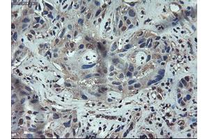 Immunohistochemical staining of paraffin-embedded Carcinoma of liver using anti-APOM (ABIN2452530) mouse monoclonal antibody. (Apolipoprotein M anticorps  (AA 23-188))