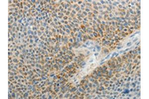 The image on the left is immunohistochemistry of paraffin-embedded Human liver cancer tissue using ABIN7189711(AGAP1 Antibody) at dilution 1/25, on the right is treated with synthetic peptide. (AGAP1 anticorps)