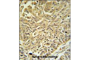 GSTK1 Antibody IHC analysis in formalin fixed and paraffin embedded lung carcinoma followed by peroxidase conjugation of the secondary antibody and DAB staining. (GSTK1 anticorps  (AA 93-120))