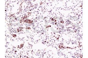 Formalin-fixed and paraffin embedded human lung carcinoma labeled with Anti-Dnmt1 Polyclonal Antibody, Unconjugated (ABIN671796) at 1:200, followed by conjugation to the secondary antibody and DAB staining (DNMT1 anticorps  (AA 21-120))