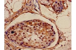 Immunohistochemistry of paraffin-embedded human breast cancer using ABIN7160901 at dilution of 1:100 (NDUFA4L2 anticorps  (AA 48-87))