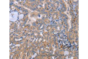 Immunohistochemistry of Human thyroid cancer using SIGLEC7 Polyclonal Antibody at dilution of 1:50